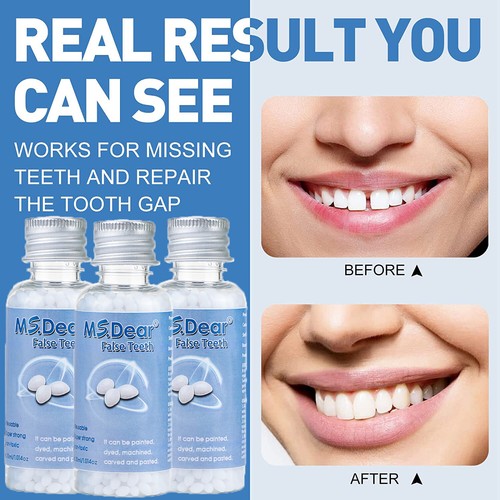 Tooth repair kit temporary - repair,