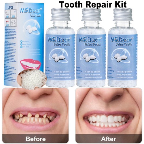 Tooth repair kit - 3x,
