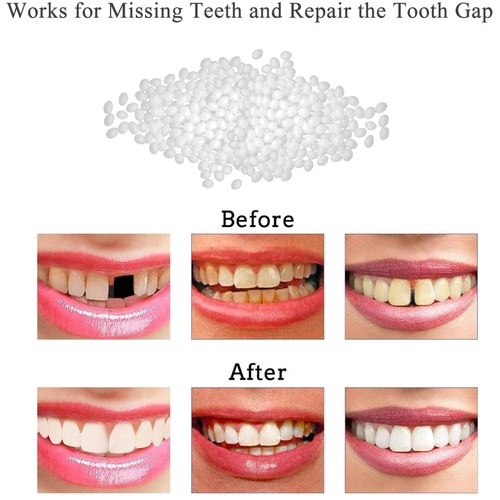 Tooth repair kit fill missing - fill,