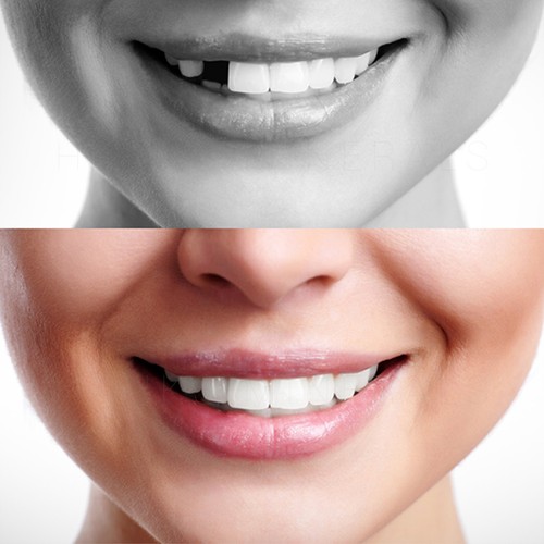 Temporary tooth repair - tooth,